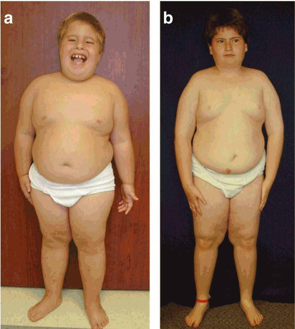 Growth hormone deficient children