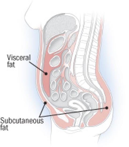 Visceral vs. subcutaneous fat