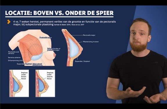 Videocollege over de plaatsing van borstimplantaten boven of onder de pectoralis major, met medische illustraties.