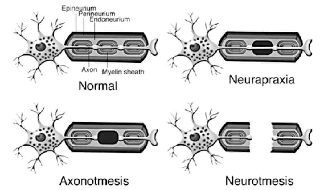 Nerve fiber injury