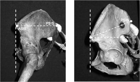 So researchers have come up with a method, using something called the ASIS-PSIS angle the tilt, to determine someone's pelvic position based on its bony landmarks rather than just visual appearance.